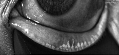 Trockenes Auge